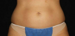 Coolsculpting to Abdomen Before